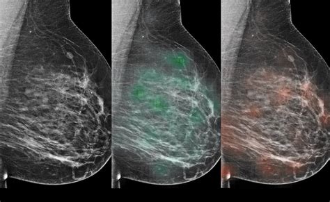 cancer de mama fotos reais